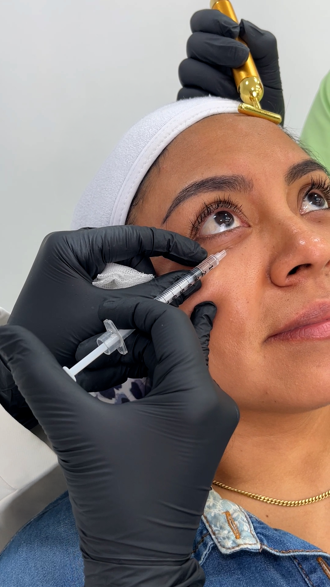 Mesoterapia de ojeras